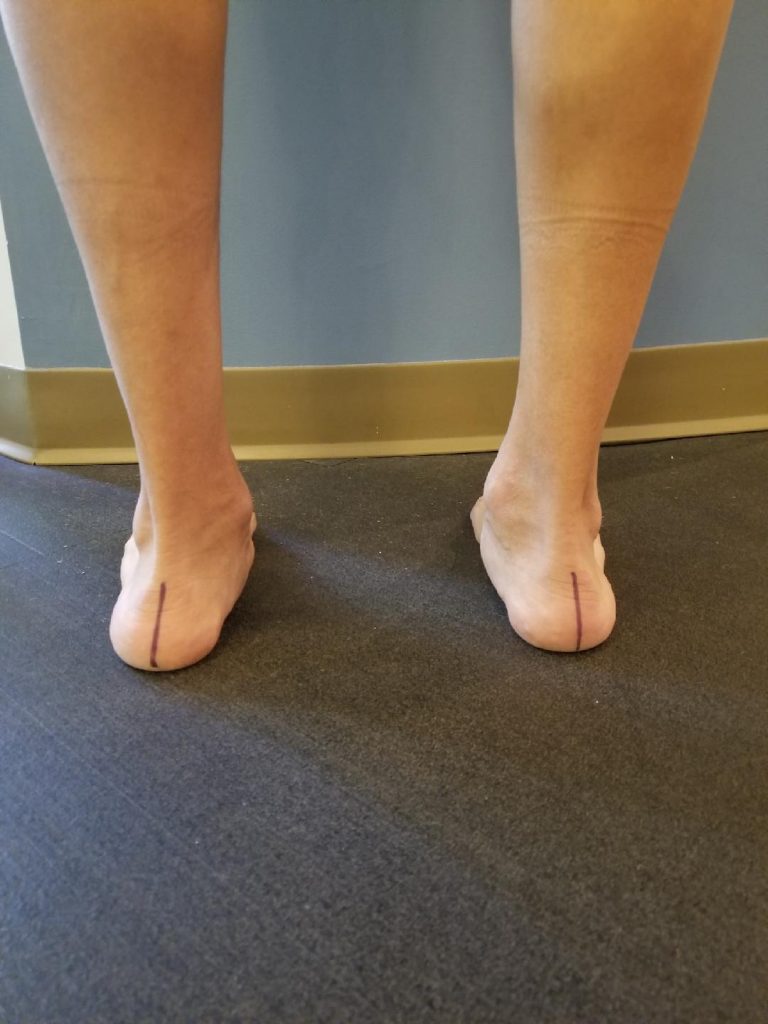 flat foot pronation