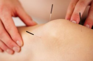 image of dry needling for the knee