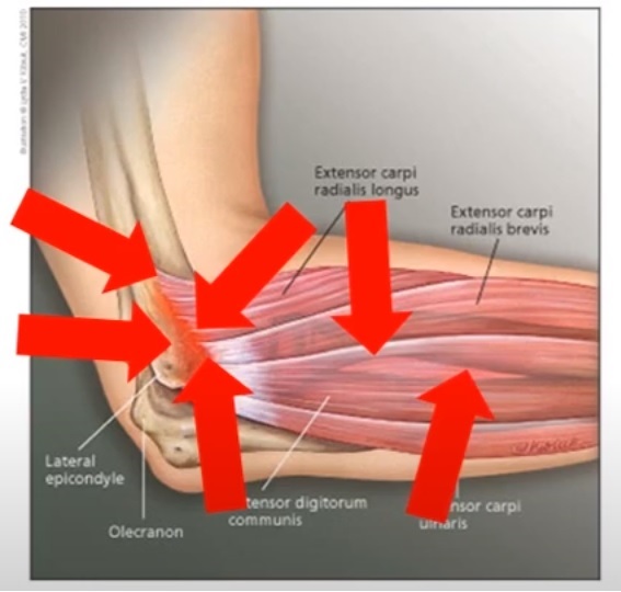 elbow-probe-locations-post-1 - IPA Physio